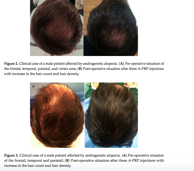 PRP for Hair Restoration  InjectAbility Clinic