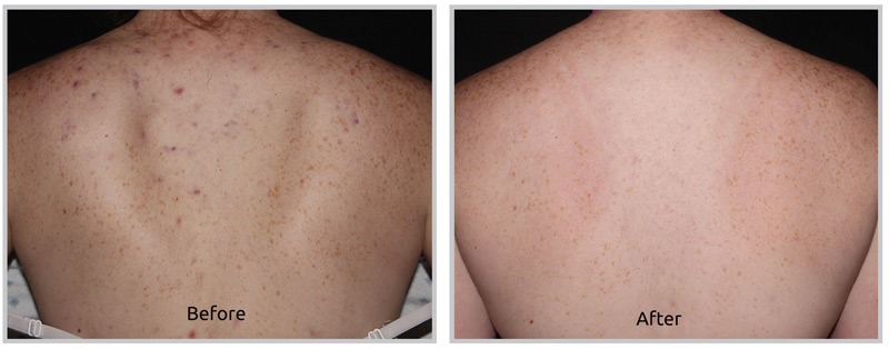 Forever Clear BBL for Acne - Pittsfield, MA
