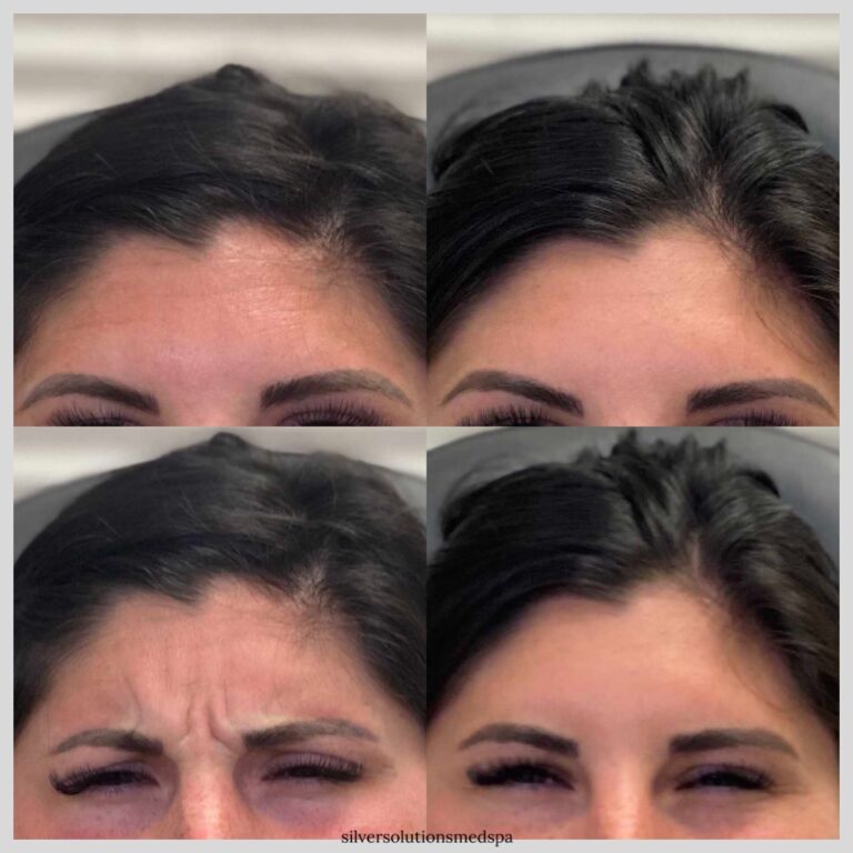 Botox Before After