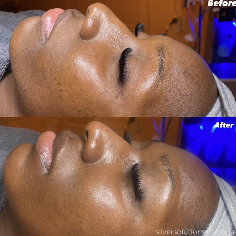 HydraFacial Before After
