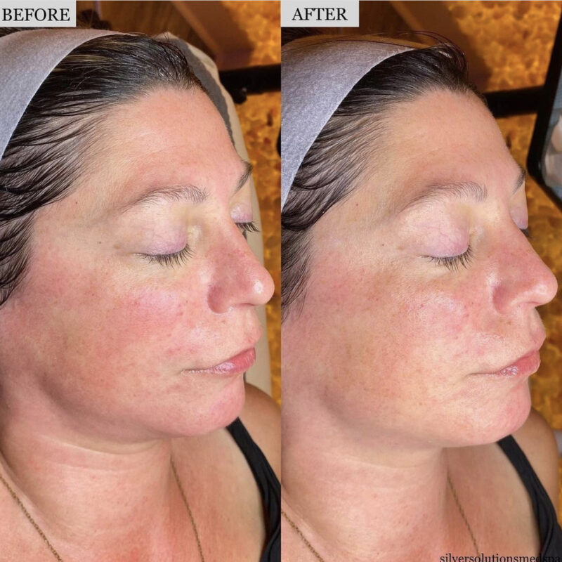 HydraFacial Before After