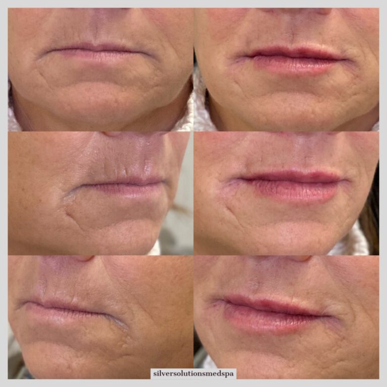 Lip Fillers Before After