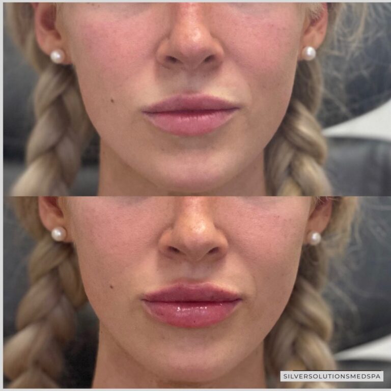 Lip Fillers Before After