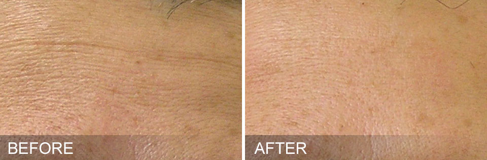 HydraFacial before after Fine Lines