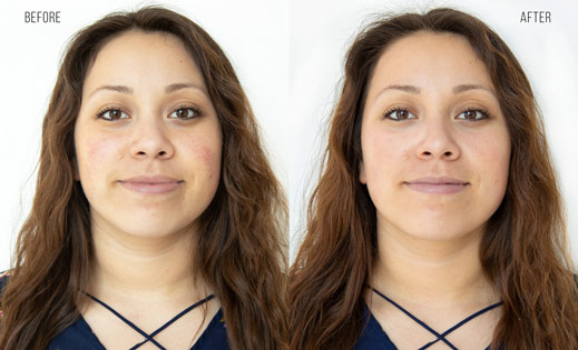 Hydrafacial before after