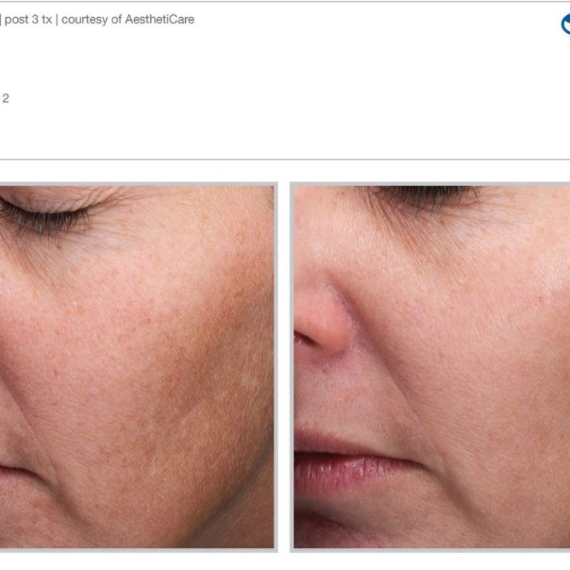 Sciton MOXI - Before and After