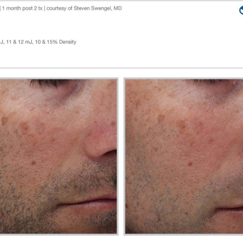Sciton MOXI - Before and After