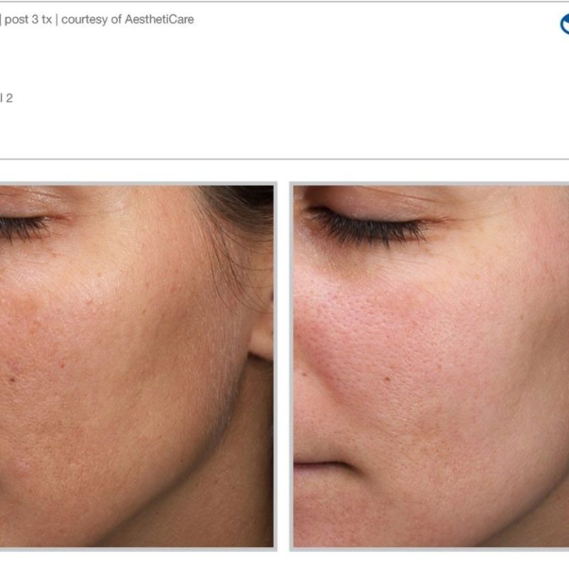 Sciton MOXI - Before and After