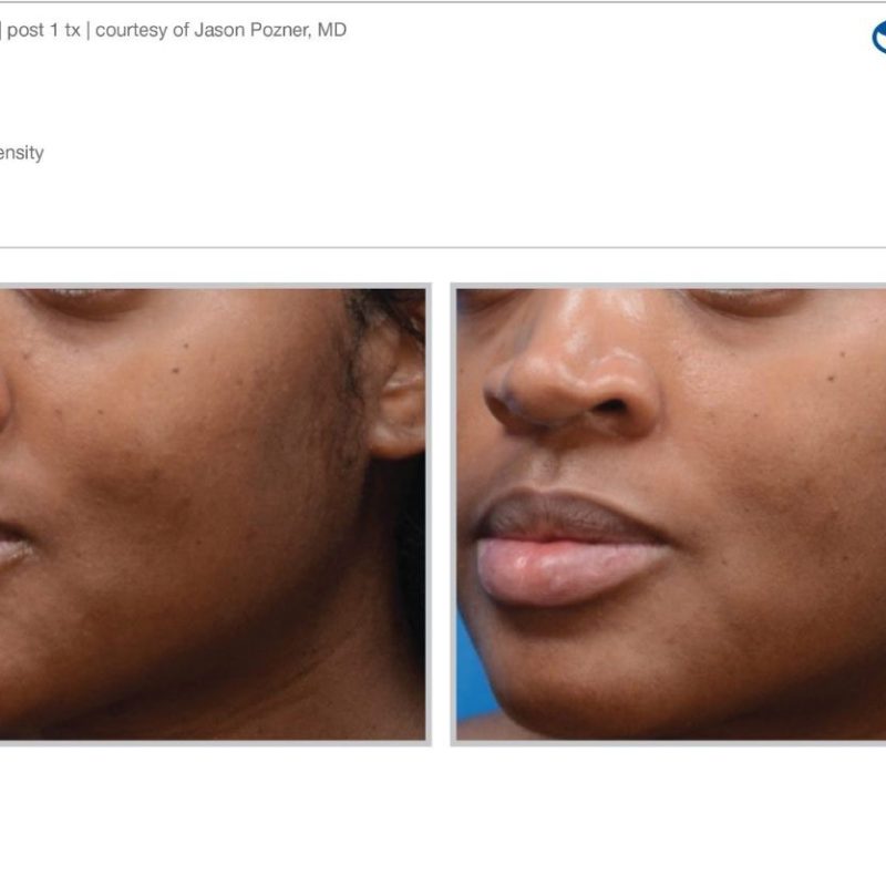 Sciton MOXI - Before and After