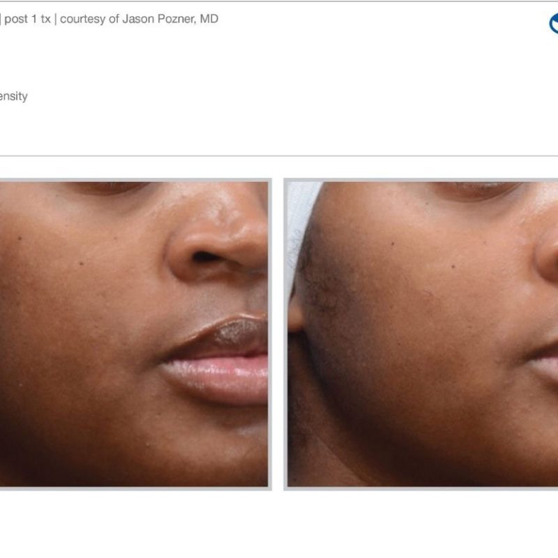 Sciton MOXI - Before and After
