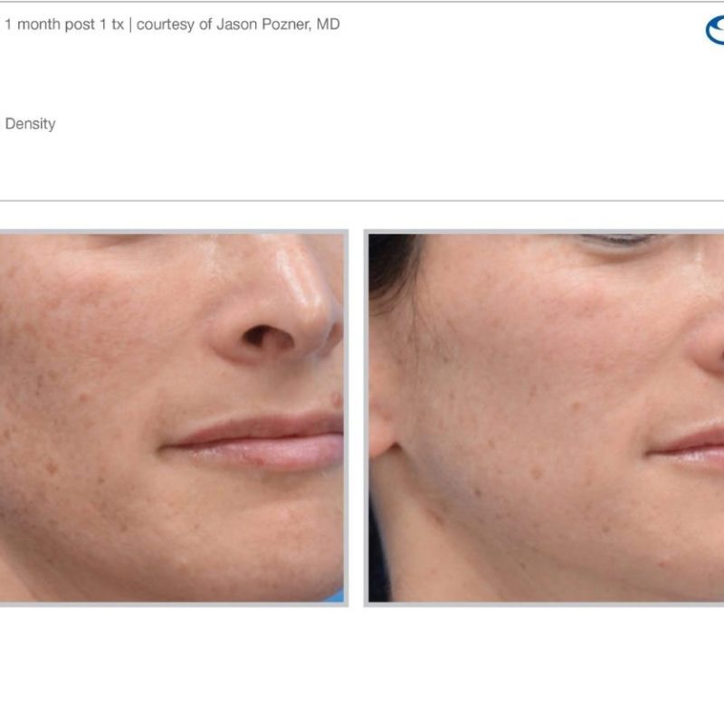 Sciton MOXI - Before and After