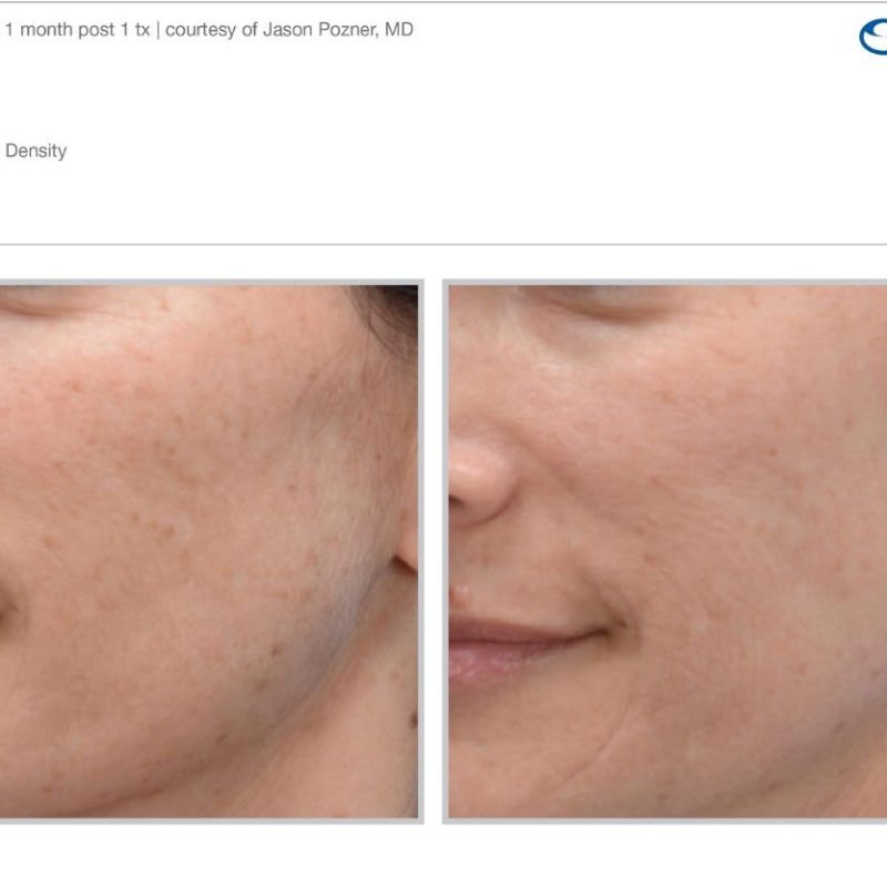 Sciton MOXI - Before and After