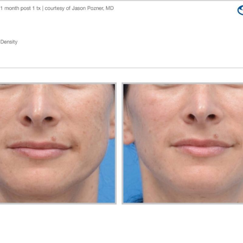 Sciton MOXI - Before and After