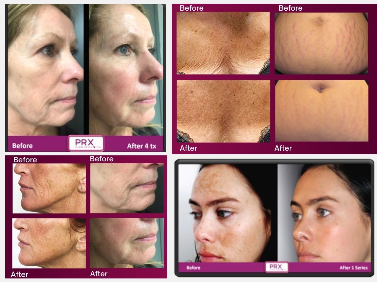 PRX-T33 Before After PRX-T33 Before After