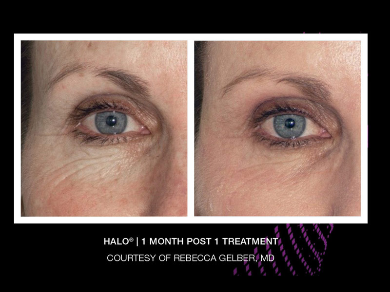 Sciton Halo Laser - Before and After