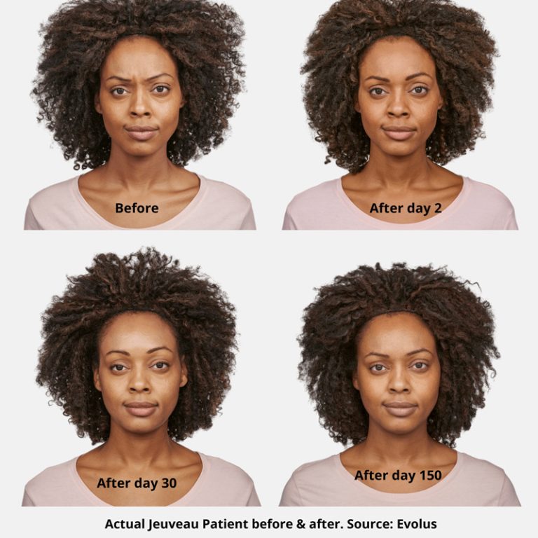 Jeuveau Before and After