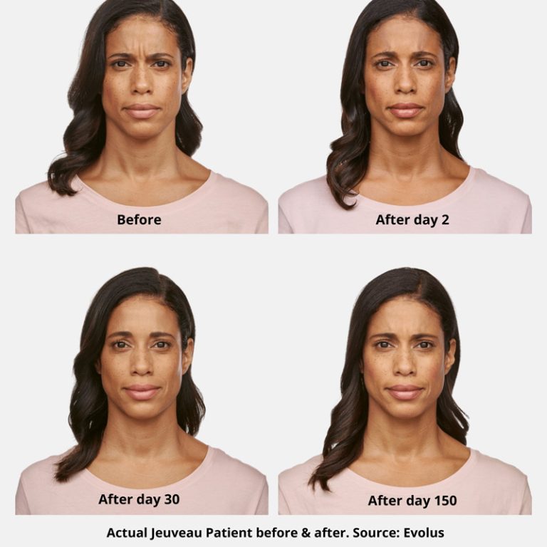 Jeuveau Before and After