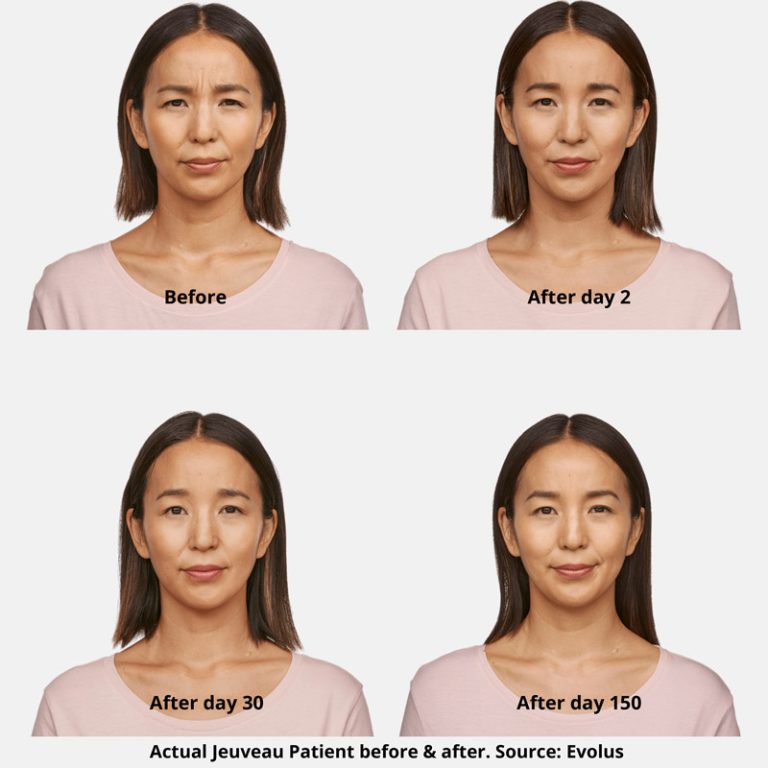 Jeuveau Before and After