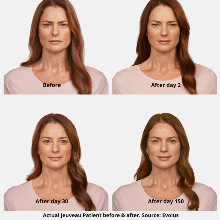 Jeuveau Before and After