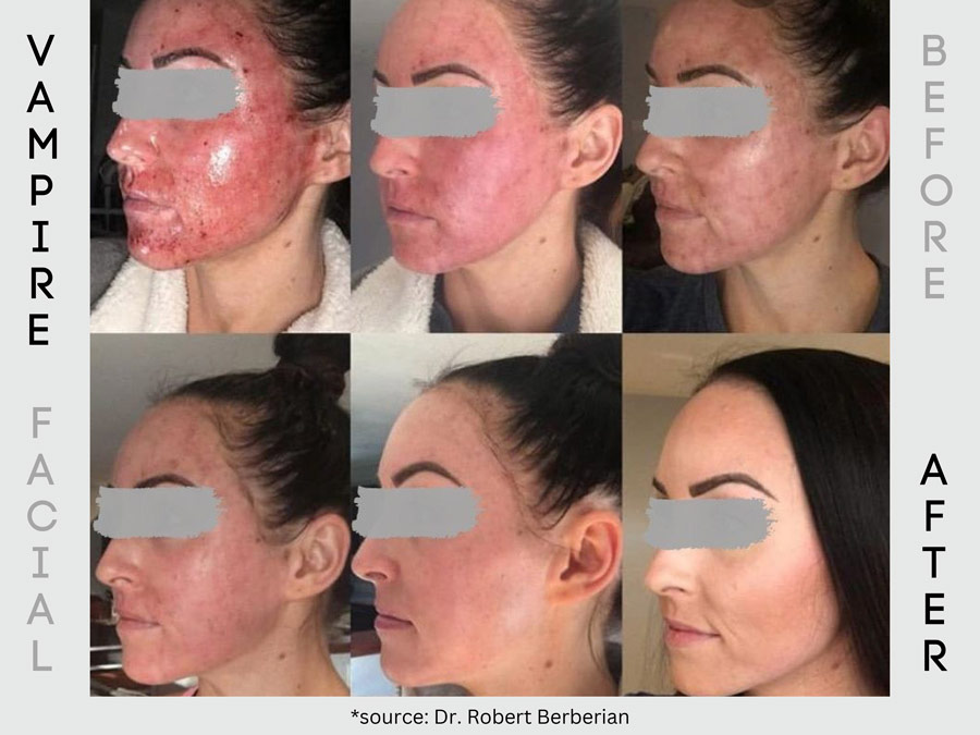 Vampire Facial - Before & After Vampire Facial - Before & After