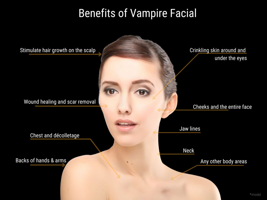 Vampire Facial Benefits