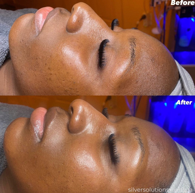 Is Hydrafacial Worth It: Unlock Radiant Skin Today