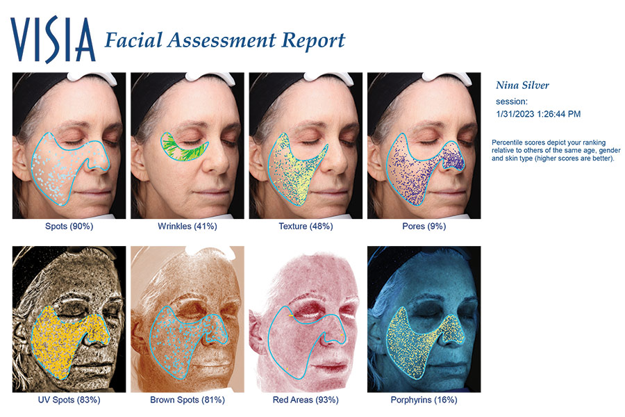 Visia Skin Analysis