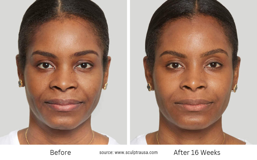 Sculptra Before and After 16 weeks