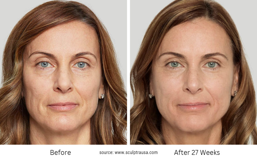Sculptra Before and After 27 weeks