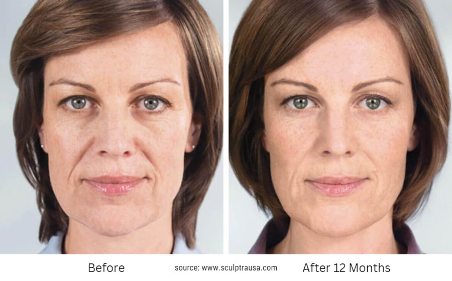 Sculptra Before and After 12 months