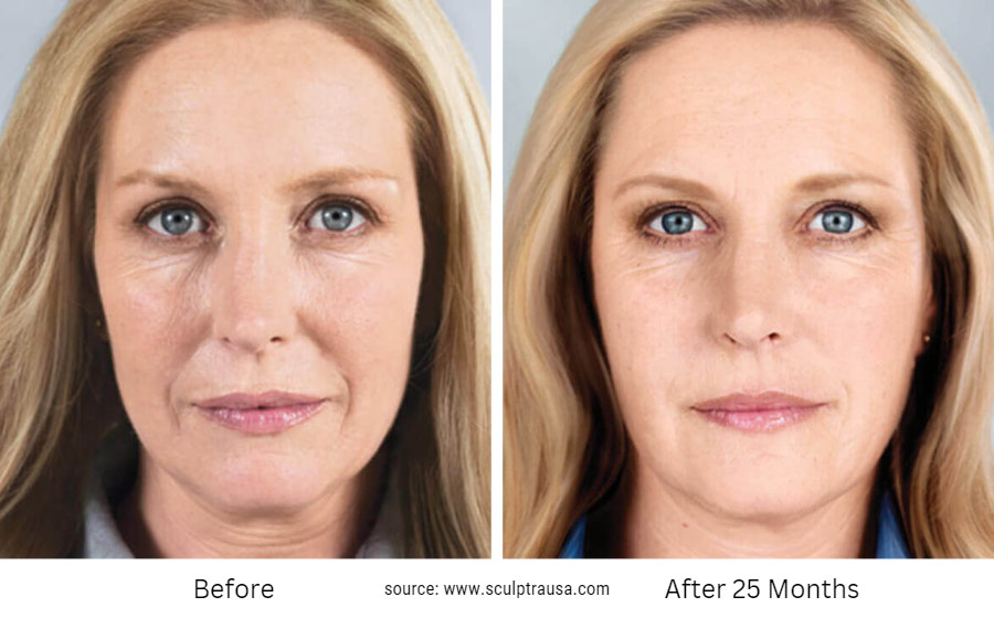 Sculptra Before and After 25 Months