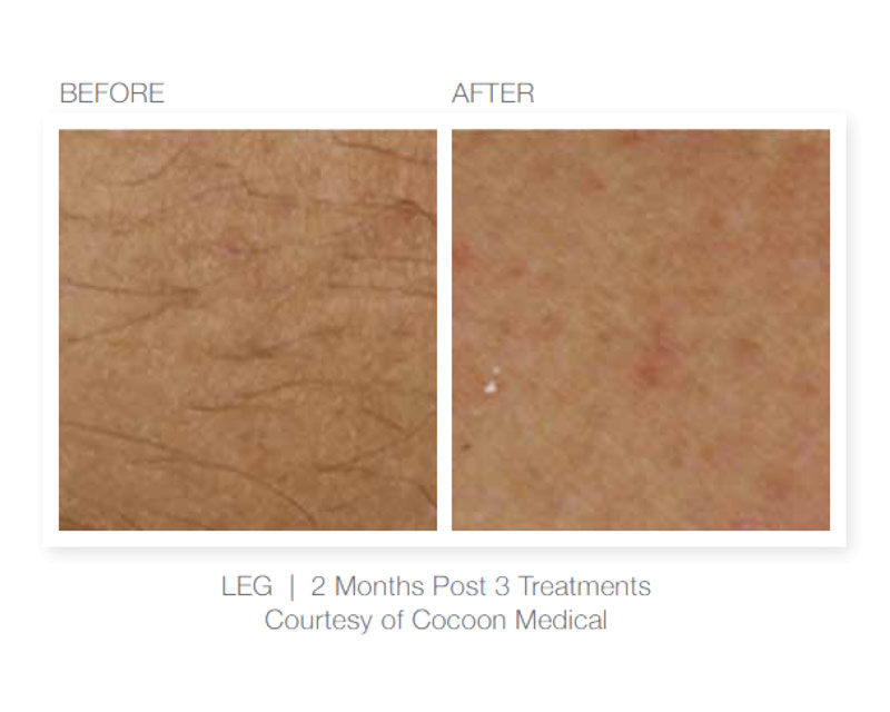 BareHR: Legs - before and after