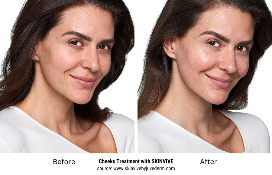 Cheeks Treatment with SKINVIVE