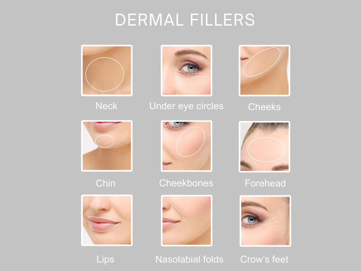 Dermal Fillers