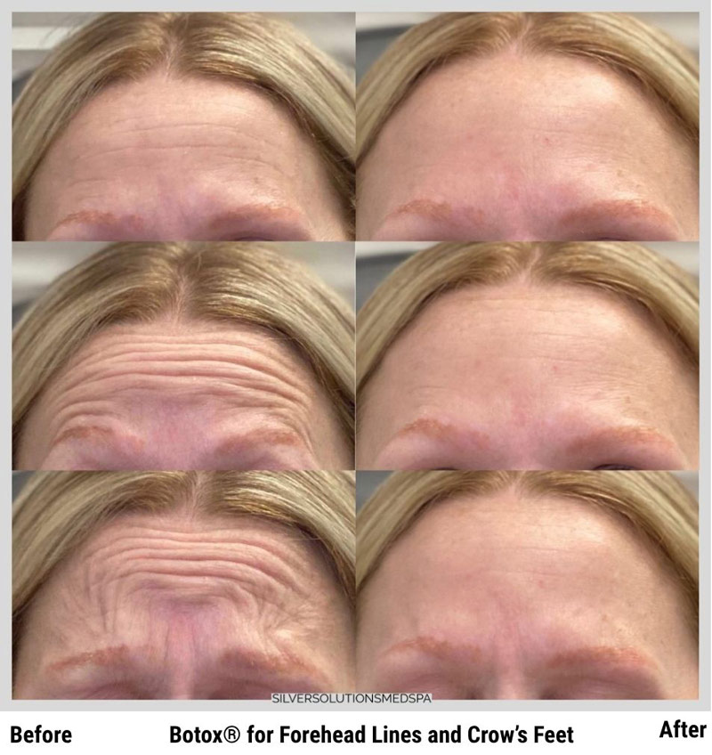 Before & After: Botox for Forehead Lines and Crow’s Feet Before & After: Botox for Forehead Lines and Crow’s Feet