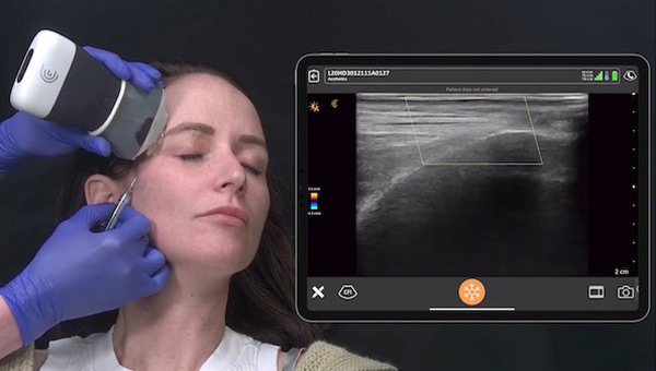 Fillers with Ultrasound